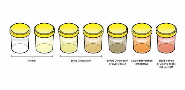 Poucos imaginam que a cor da urina pode revelar muito sobre sua saúde