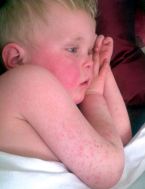 Scarlet fever: symptoms, infection and treatment in children and adults (photos)