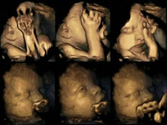 Fumar na gravidez é ruim para o feto. Os testes em um eco 4D