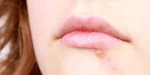 Stomatitis: symptoms, causes and possible remedies
