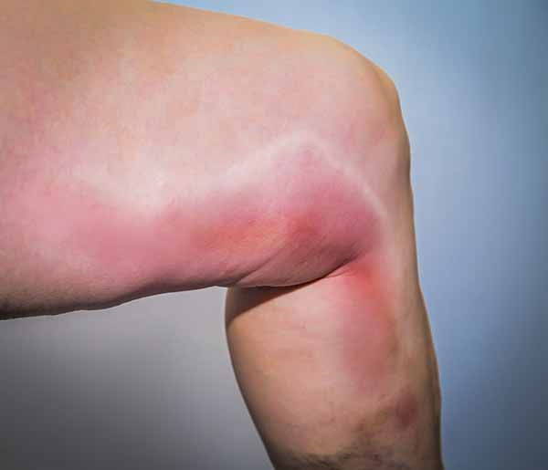 Phlebitis: symptoms, causes, remedies and how to recognize venous thrombosis (photo)