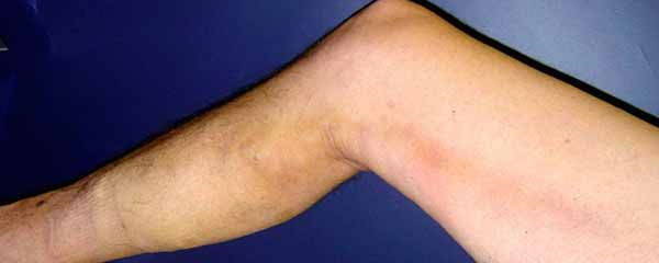 Phlebitis: symptoms, causes, remedies and how to recognize venous thrombosis (photo)