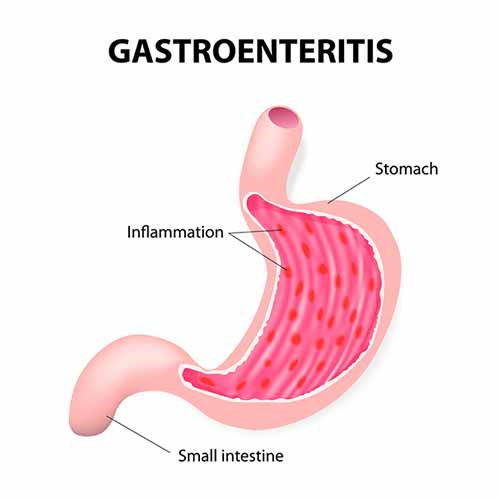 Gastroenteritis: causes, symptoms and remedies in children and adults