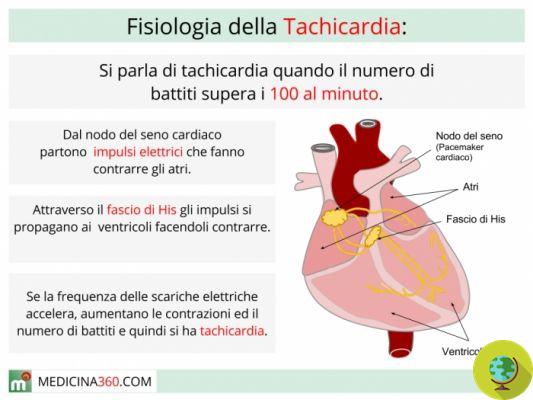 Taquicardia: tipos, causas y cómo intervenir