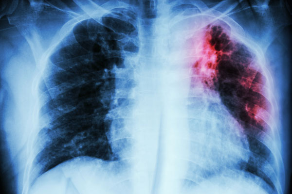 Tuberculosis: síntomas, causas y cómo se transmite