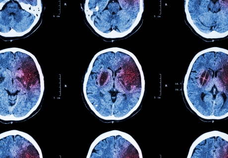 Estimular el nervio vago puede cambiar la vida de los pacientes con accidente cerebrovascular. yo estudio