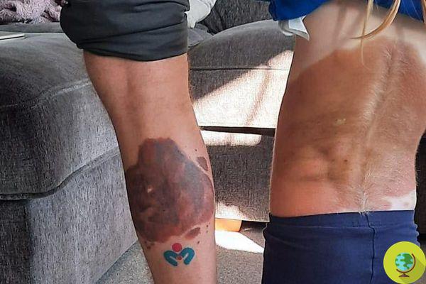 Este padre se tatuó una marca de nacimiento como la de su hija de 5 años para que se sintiera cómoda