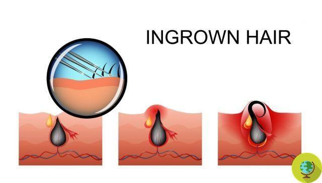 Ingrown hair: causes, remedies and how to prevent them