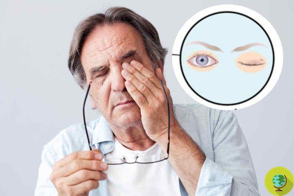 Vitamin B12 deficiency: This eyelid sign may alert you to low levels