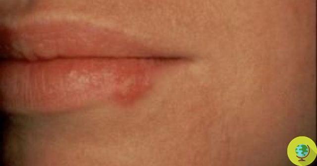 Cold sores: a vegetable gel to combat it
