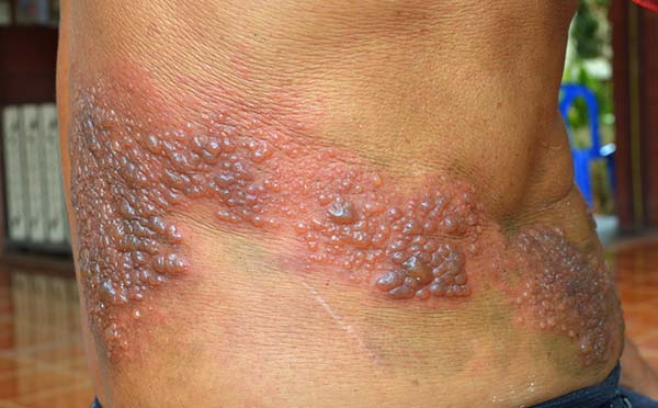 Herpes zoster: o que é, sintomas e como se manifesta