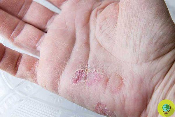 Psoriasis: the skin disease that discriminates