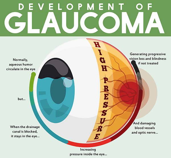 Glaucome : qu'est-ce que c'est, ses causes, ses symptômes d'alerte et son traitement