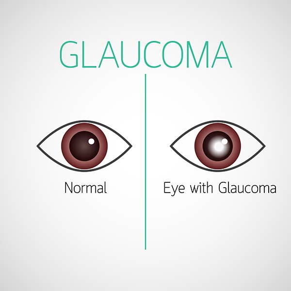 Glaucoma: qué es, causas, síntomas de alarma y tratamiento
