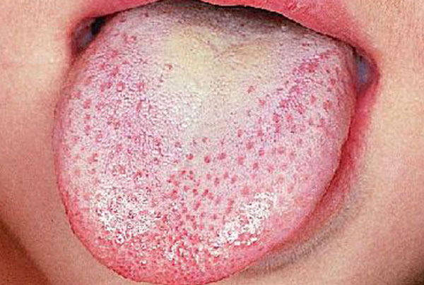 Scarlet fever: how to recognize it and how long the incubation lasts (PHOTO)