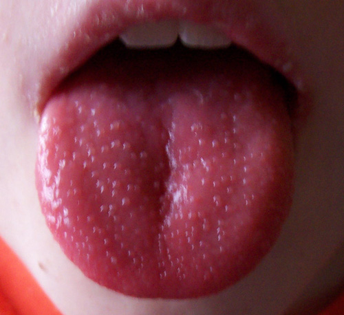 Scarlet fever: how to recognize it and how long the incubation lasts (PHOTO)