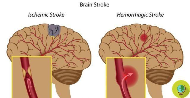 Stroke: The risk increases if you have frequent memory loss