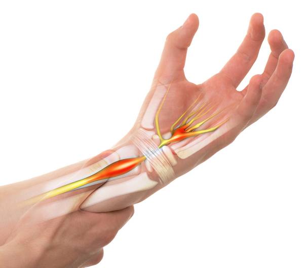 Carpal tunnel syndrome: symptoms, remedies and how to recognize it