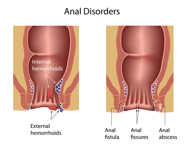 Fissures anales : symptômes et remèdes naturels pour soulager l'inconfort