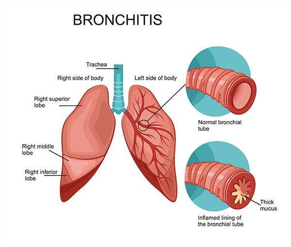 Asthmatic bronchitis: causes, symptoms and remedies