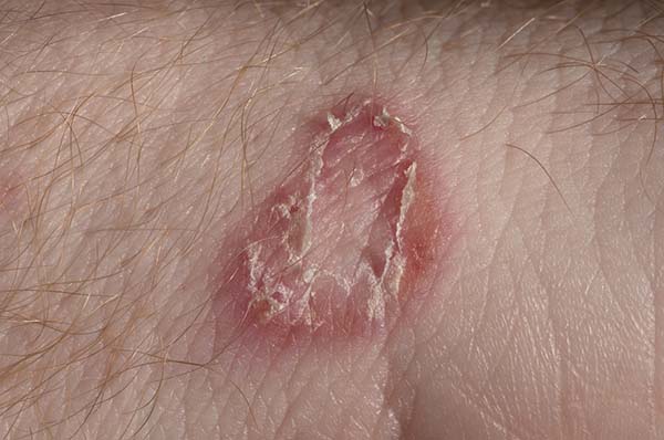 Ringworm: causes, symptoms, remedies and how to recognize it (photo)