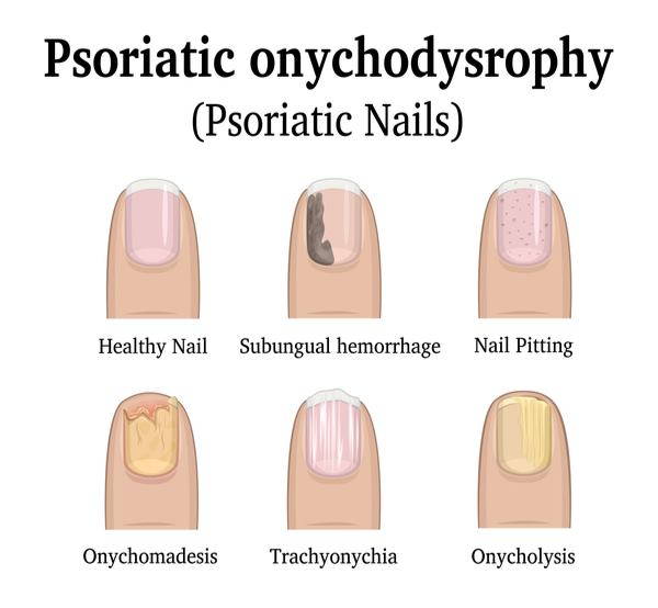 Nail psoriasis: causes and symptoms of nail psoriasis to be reckoned with