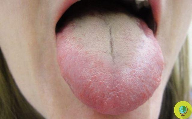 White tongue: causes and remedies to eliminate the patina