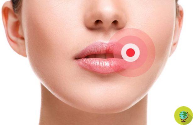 10 remedios naturales para curar el herpes labial
