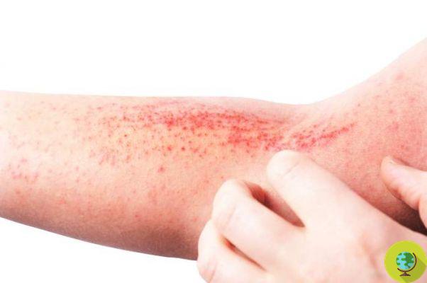 Dermatitis: qué es y cómo tratarla