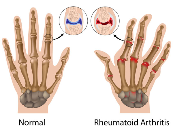 Artritis reumatoide: síntomas, causas y remedios