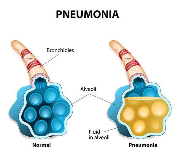 Pneumonia: symptoms, prevention and treatment in children and adults
