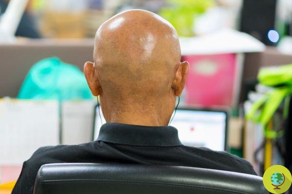 Overworking is twice as likely to go bald. The study of 13 thousand men