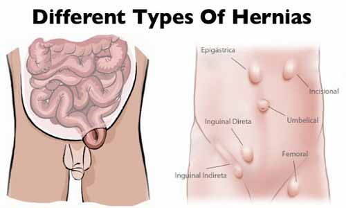 Inguinal hernia: symptoms, causes and possible remedies