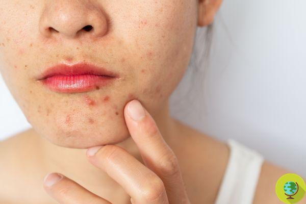 Acne: 10 foods to prevent it and 5 to avoid