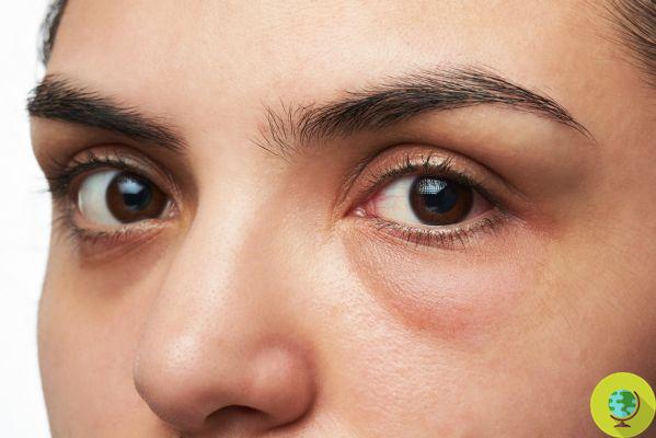 Bags under the eyes: causes and how to eliminate them with natural remedies