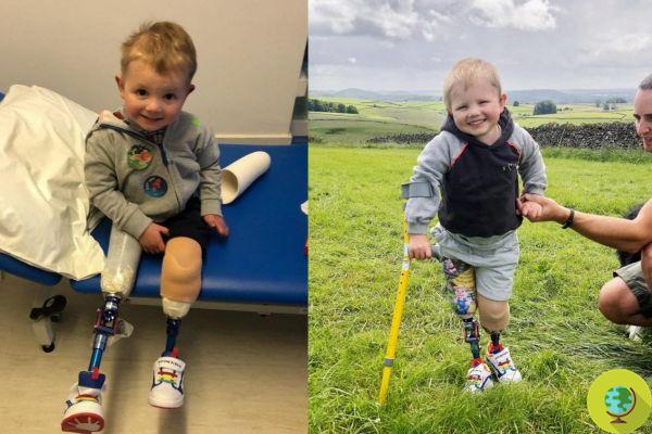 Un garçon de 4 ans marche à nouveau grâce à ses nouvelles prothèses. La vidéo des premiers pas est une caresse au coeur