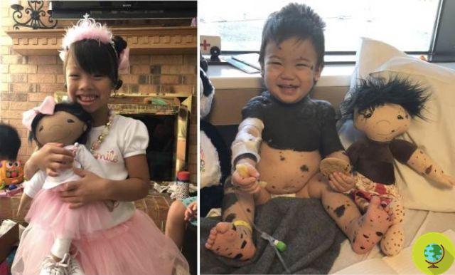 The mother who makes dolls with the same disabilities as children