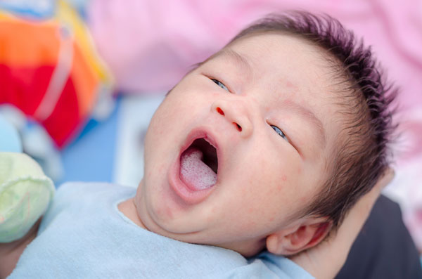 Thrush: Symptoms, Cause, and Remedies in Infants and Adults