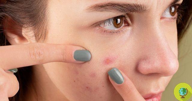 Why do we feel pleasure when we squeeze pimples and blackheads?