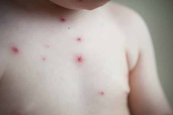 La varicelle chez l'enfant : comment la reconnaître et les remèdes pour soulager les démangeaisons (photos)