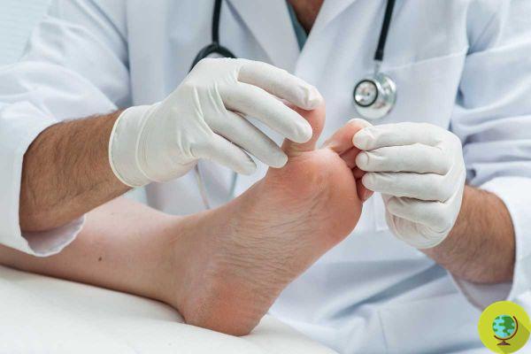 Diabetes, keep an eye on your feet: 4 signs on your toes you should never ignore