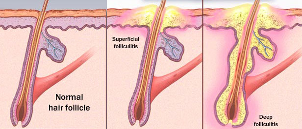 Folliculitis: symptoms, causes and natural remedies