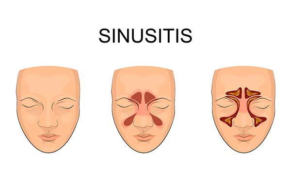 Sinusitis: causes, symptoms and natural remedies
