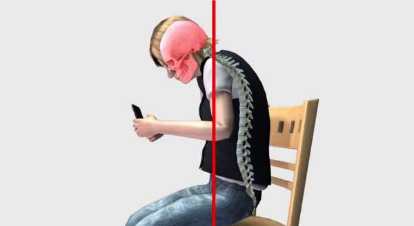 Les enfants qui utilisent trop de smartphones et de tablettes ont tendance à développer une bosse et une colonne vertébrale incurvée