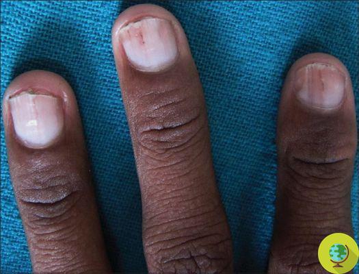 High Cholesterol: If you have this color of nails, this could be a warning sign you shouldn't ignore