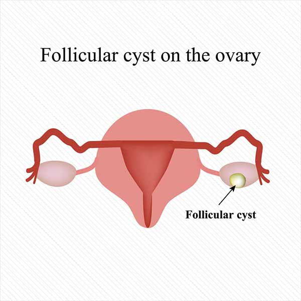 Polycystic ovary: symptoms, causes, consequences and diet to follow