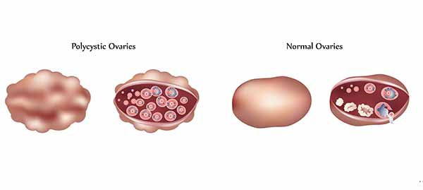 Ovario poliquístico: síntomas, causas, consecuencias y dieta a seguir