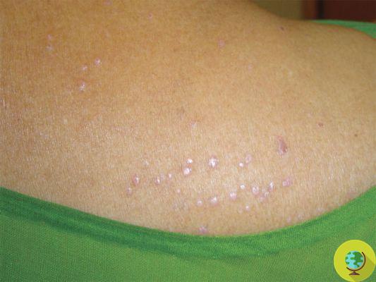 Vitamina B12: Se você tiver esses sintomas na pele, pode estar com deficiência