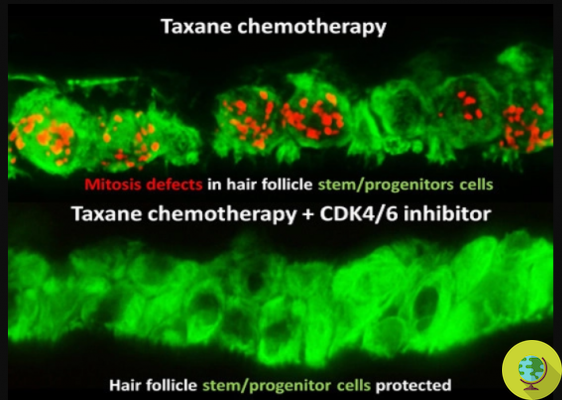 Cáncer de mama: descubierto mecanismo para frenar la caída del cabello en quimioterapia