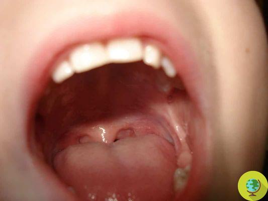 Plaques in the throat: symptoms, causes and the most effective natural remedies